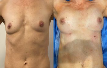 🥇 Fat to Breasts in Thin Patients