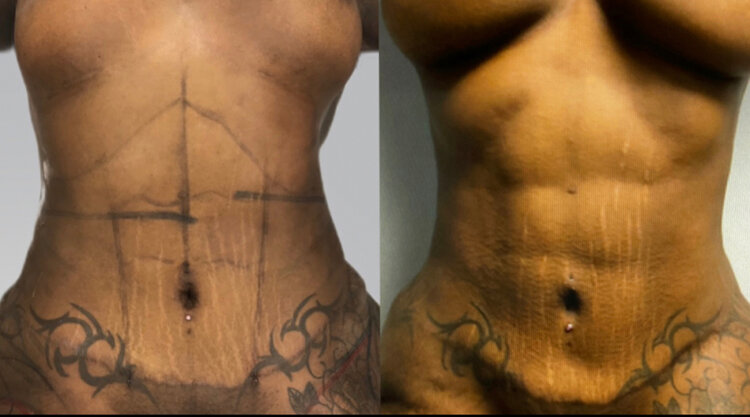 🥇 NYC HD Abdominal Etching Before and After Pictures